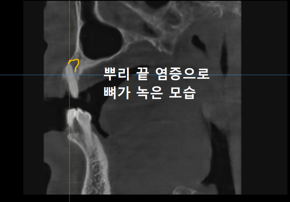 뿌리만 남은 치아, 그대로 두면 왜 위험할까요? 고덕동 전체 임플란트 재건 사례 관련 이미지 1