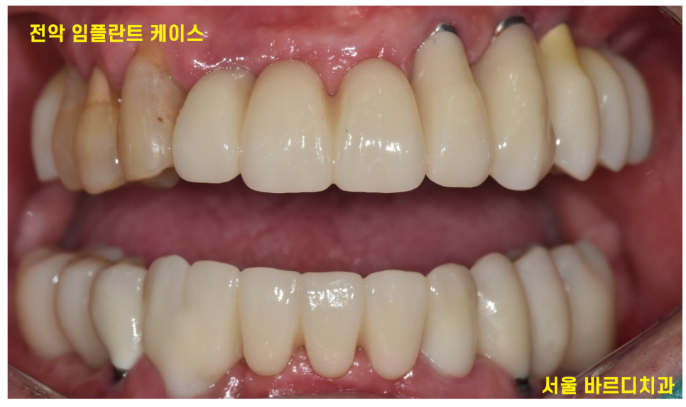 상일동 임플란트 잘하는곳 치료는 이렇게 진행됩니다. 관련 이미지 8