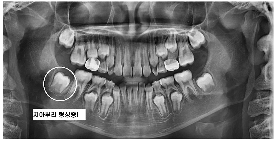 미사역 임플란트 치료 나이 상관이 있을까? 관련 이미지 1