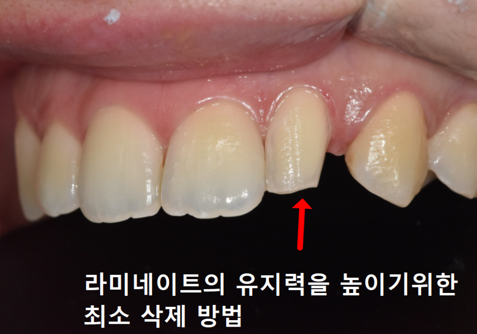 강일동 라미네이트 가격 망설여질 때 꼭 확인해야 할 관련 이미지 10