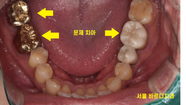강일동 치과 잇몸뼈 녹음 발치 후 임플란트로 해결했습니다. 관련 이미지 5