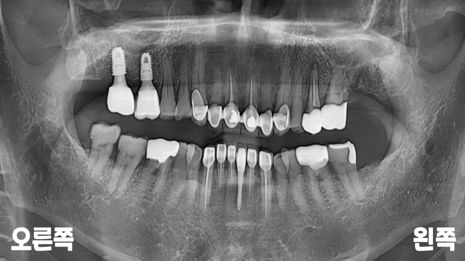 서울바르디치과 뿌리 끝 염증 심한 치아를 네비게이션 임플란트 #6 관련 이미지 6