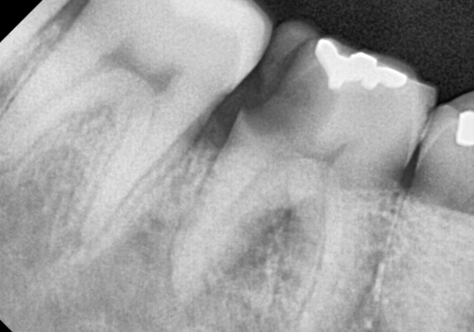 고덕동 어금니 사이 충치, 양치질 누구보다 열심히 하는데 왜 자꾸 생길까요? 관련 이미지 3