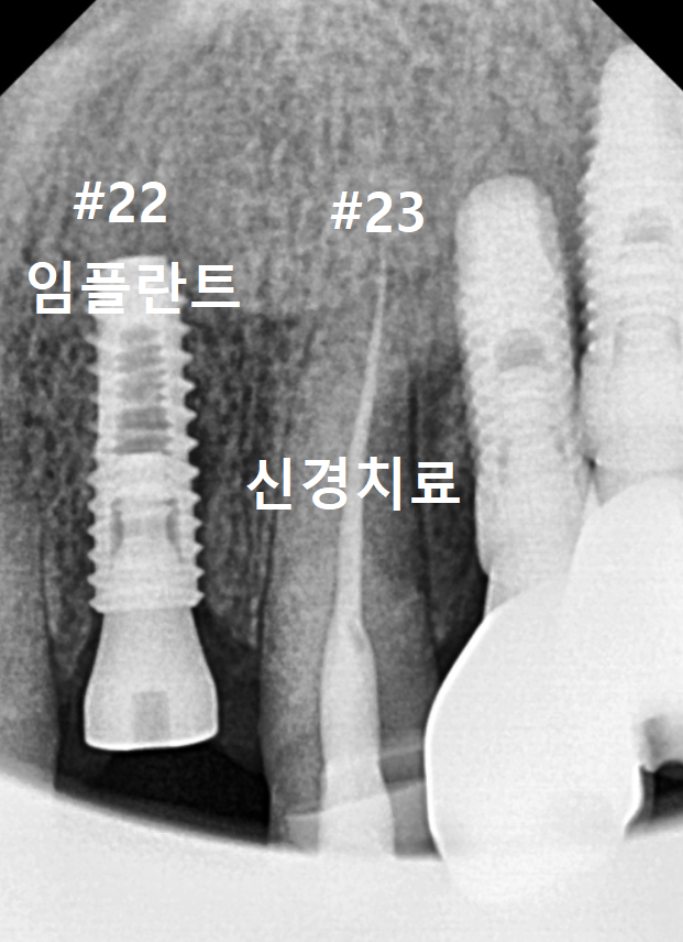 고덕역치과, 잇몸 패임(치경부 마모) 레진 치료, 왜 자꾸 떨어지나요? 관련 이미지 10