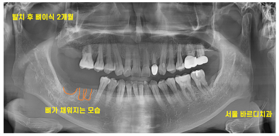 이 흔들림으로 발치 후 뼈이식 진행한 케이스 관련 이미지 7