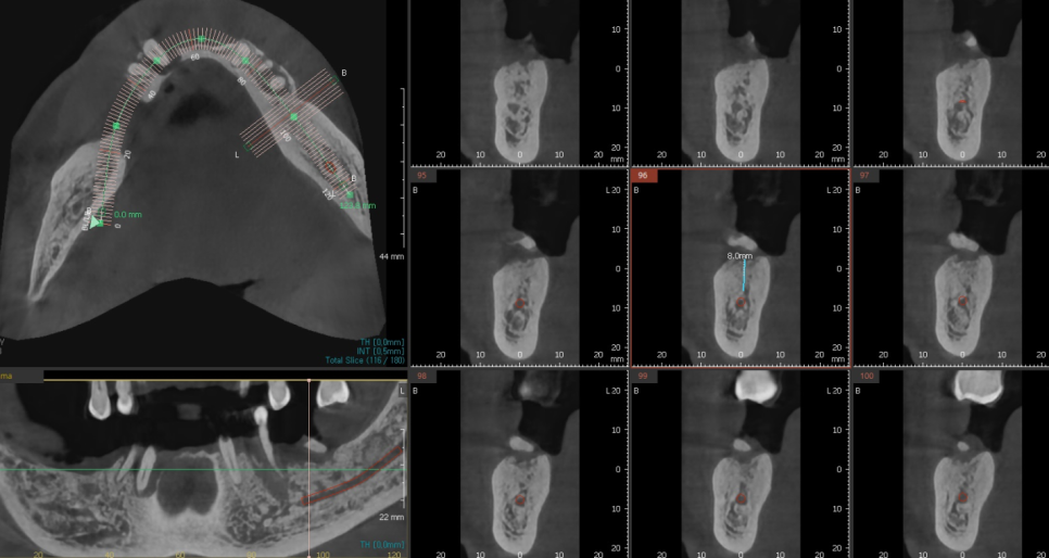 상일동 임플란트 잘하는곳 치료는 이렇게 진행됩니다. 관련 이미지 5