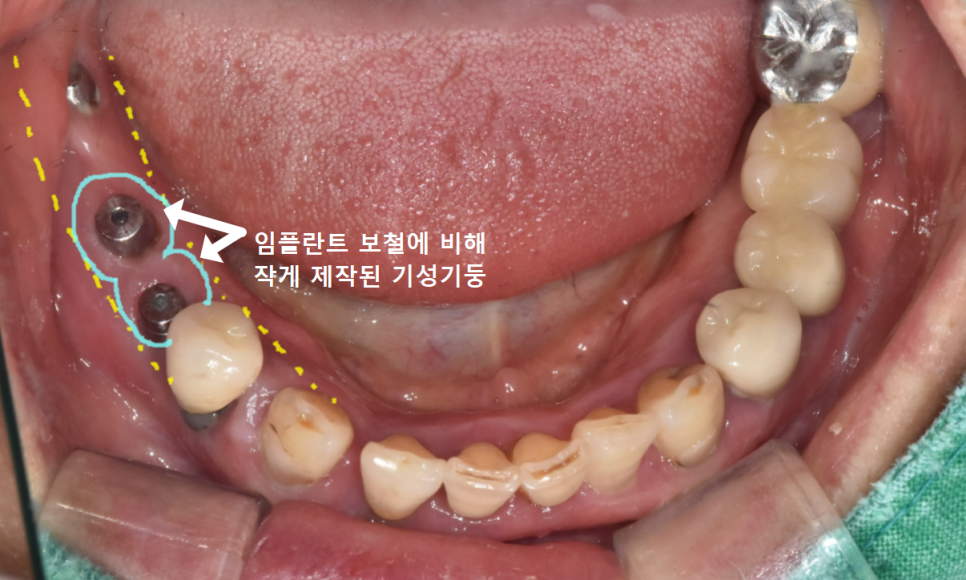고덕동치과, 보험 임플란트? 추가 비용이 왜 나오는 거죠? 관련 이미지 7
