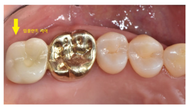 임플란트 수명 유지 관리 방법 도대체 어떻게 해야하나요? 관련 이미지 2