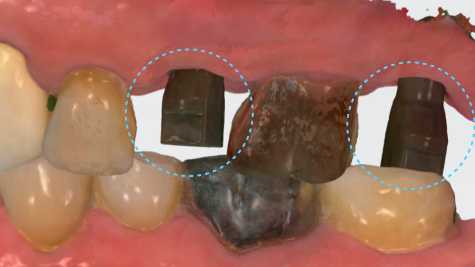서울바르디치과 뿌리 끝 염증 심한 치아를 네비게이션 임플란트 #6 관련 이미지 14