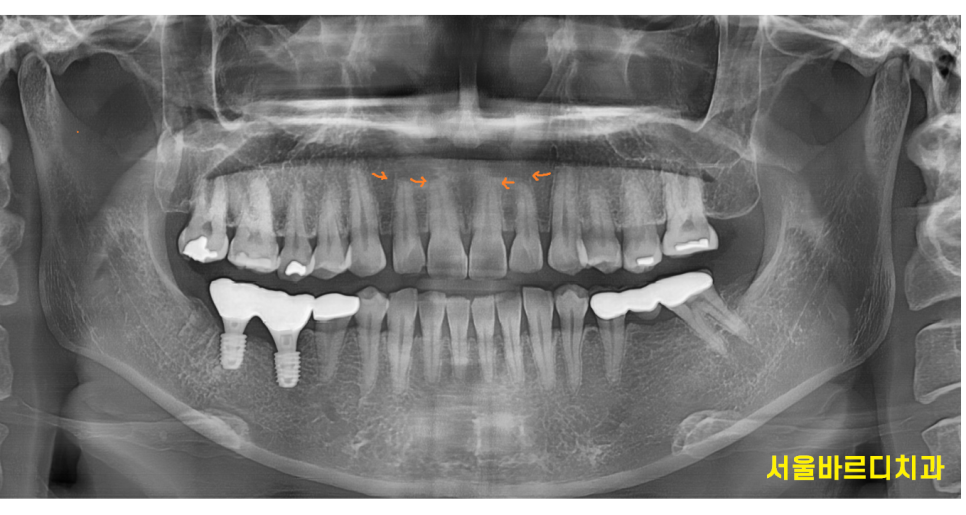 고덕동 교정치과 앞니 사이 틈 부분교정으로 치아 삭제없이 공간 없애기 관련 이미지 5