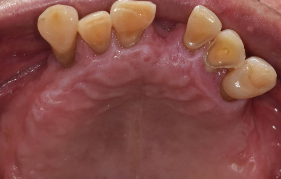 치아 상실 치료 치과 브릿지? 임플란트? 무엇이든 시도하세요. 관련 이미지 5