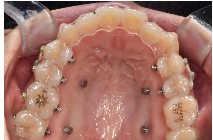 고덕동 투명교정 인비절라인도 철사를 붙일 수 있습니다. 관련 이미지 3