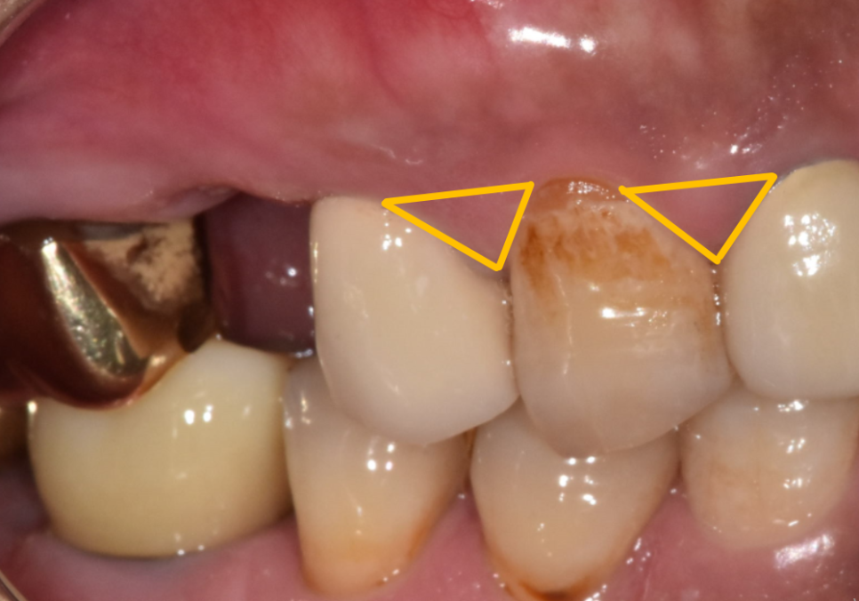 상일역 임플란트, 음식물 끼는 이유, 처음엔 안 그랬는데 왜 점점 심해지는 걸까요? 관련 이미지 3