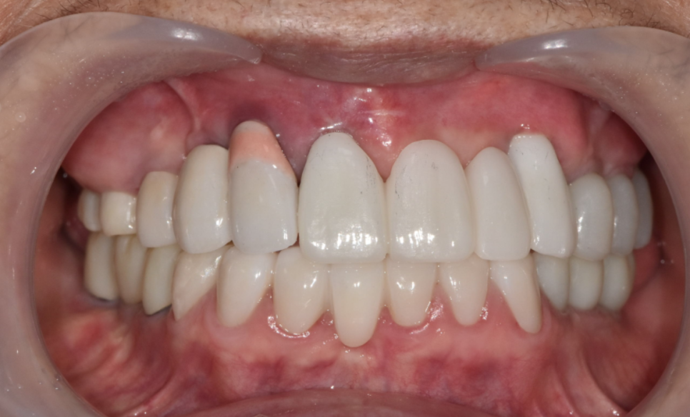 합죽이입 처럼 보이는 이유, 낮아진 관련 이미지 12