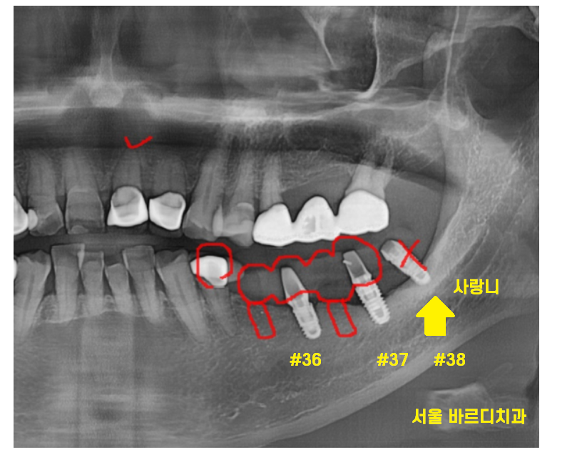고덕동치과 이가 다 부서졌을 때 임플란트 치료했습니다. 관련 이미지 4