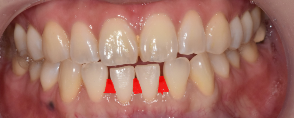 벌어진 아래 앞니 라미네이트로 감쪽같게 치료했습니다. 관련 이미지 4