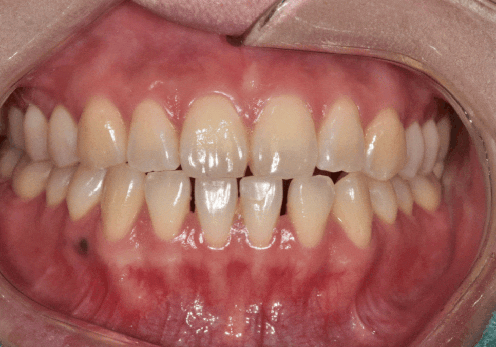 앞니 라미네이트, 치아 시림 고민 덜 수 있는 해결 방법 공개합니다. 관련 이미지 5