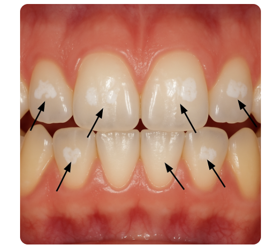 치아에 생긴 하얀 얼룩, 왜 생기나요? 초기 충치일 수 있습니다. 관련 이미지 1
