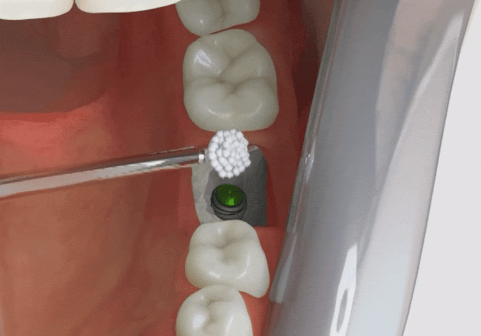 강동구 치아 뿌리 염증, 신경치료 한 치아인데도 아플 수 있나요? 관련 이미지 10