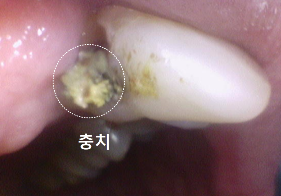 대문니 빠짐, 앞니 빠졌을 때 브릿지와 임플란트 중 나에게 맞는 선택은? 관련 이미지 5