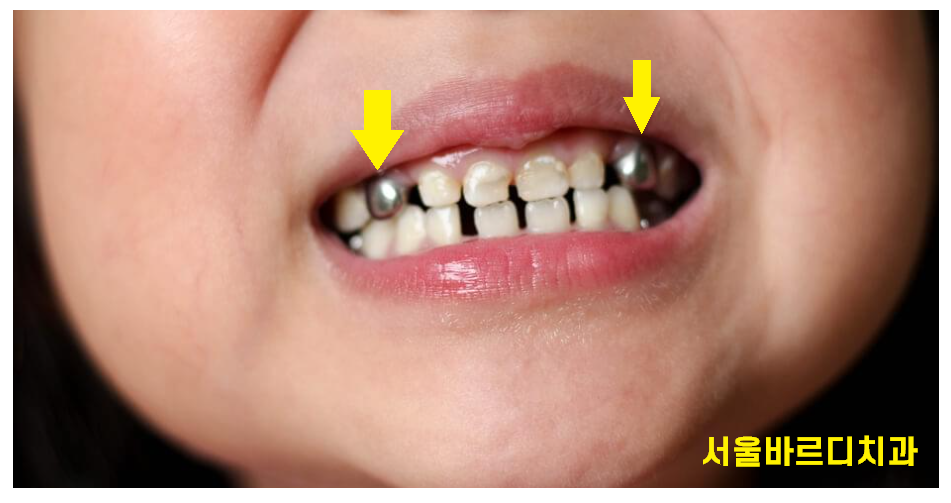 상일동 어린이치과 유치 곧 뽑을 치아이지만 치료가 필요한 이유 관련 이미지 4