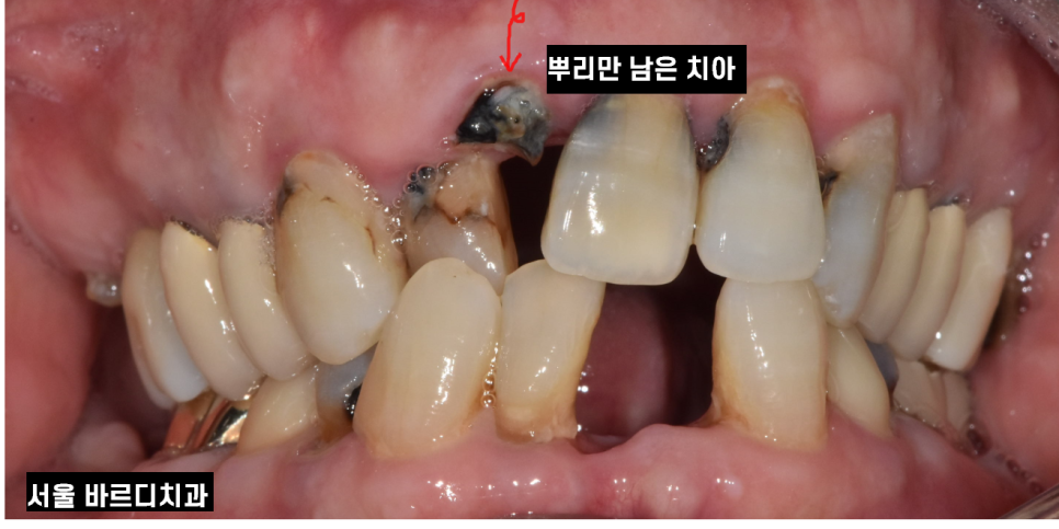 입 마름 치근 우식증이 쉽게 생길 수 있습니다!! 관련 이미지 4