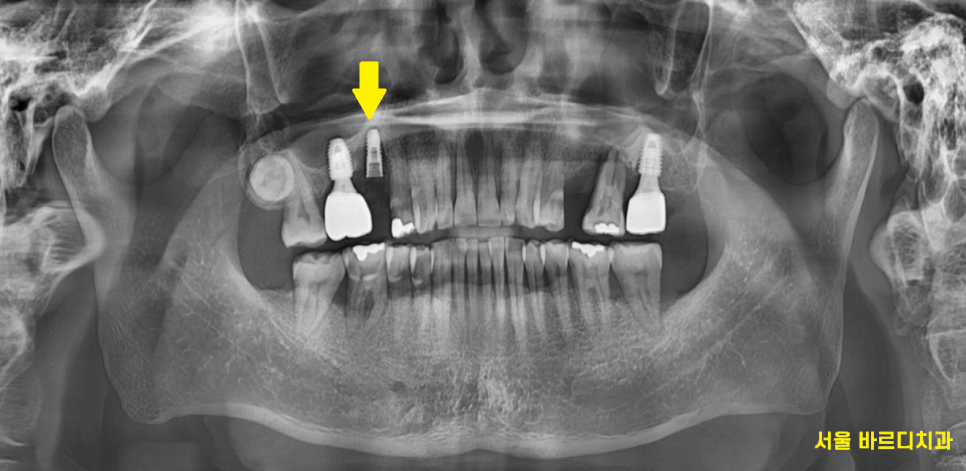 상일동 치과 잇몸 내려감 치료는 임플란트로 관련 이미지 7