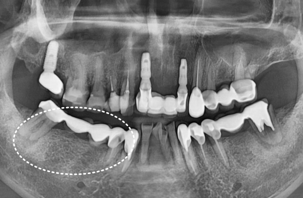오래된 어금니 롱브릿지, 교체 타이밍을 놓치면 관련 이미지 4