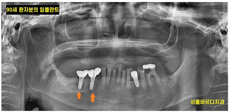 미사역 임플란트 치료 나이 상관이 있을까? 관련 이미지 2
