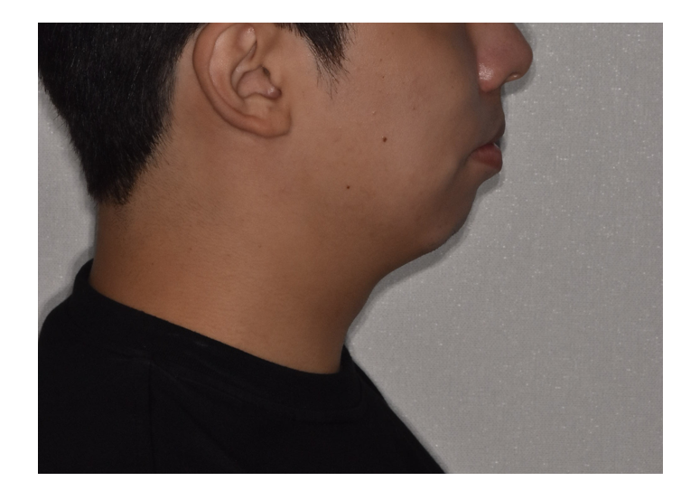 Adult Chin Correction: It Can Go Beyond Appearance Issues and Even Disturb You During Sleep image 2