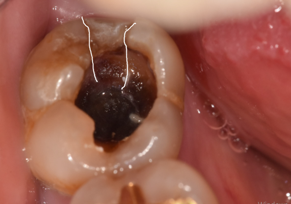 고덕동 스케일링 미루다 앞니 어금니 다 뽑고 임플란트 했습니다. 관련 이미지 8