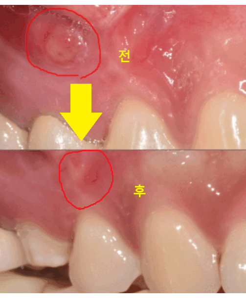망월동 치과 재신경치료 자연치아 살리기 끝판왕 치료 mta로 가능했습니다. 관련 이미지 1