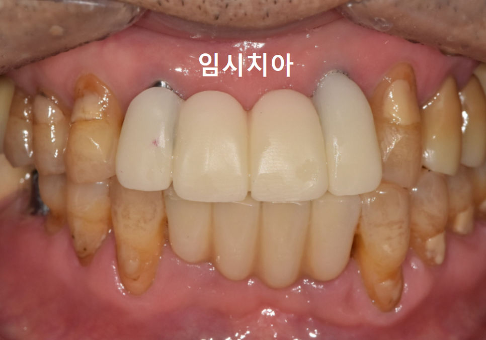 Honestly, Can an Unbroken Temporary Tooth Be Used Without a Crown? image 2
