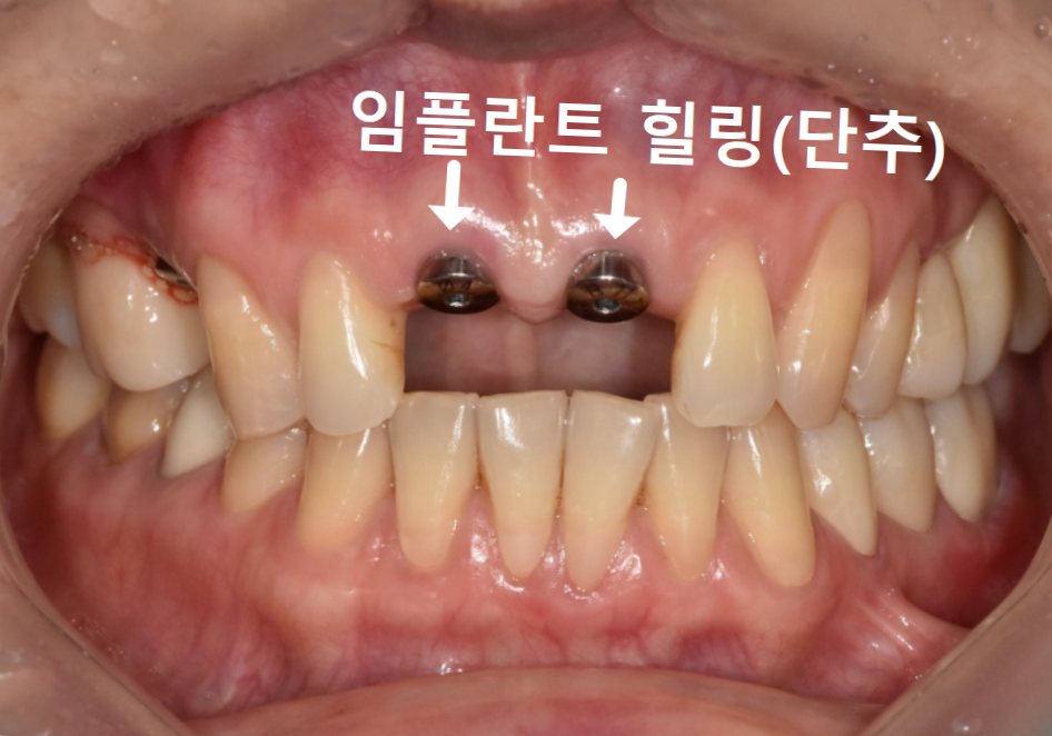 잇몸 까매짐 원인,증상,치료 방법 오래전에 앞니 씌운 곳 잇몸이 까매졌어요. 관련 이미지 12