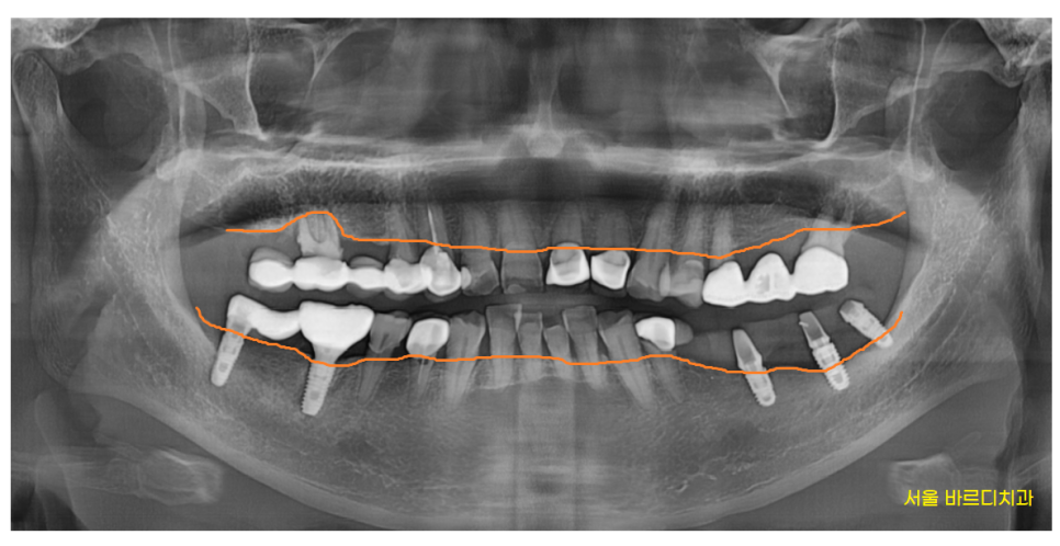 망월동 치과  양쪽 어금니 문제가 있을때 치료 순서는? 관련 이미지 2