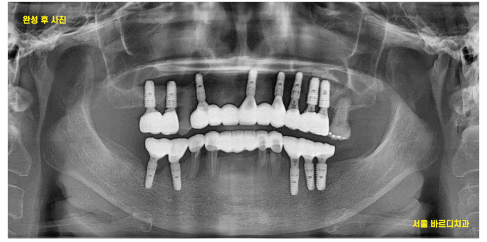 암사동 치과 전악 임플란트 하루만에 끝냈습니다. 관련 이미지 1