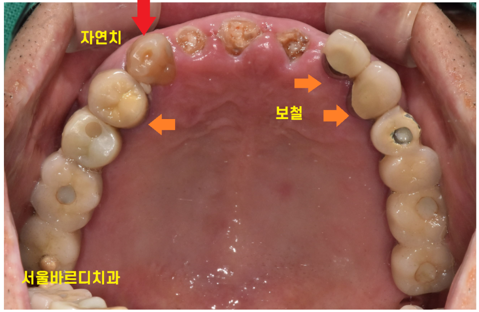 상일동역 치과 부러진 앞니 임플란트로 복구하기 프로젝트 관련 이미지 5