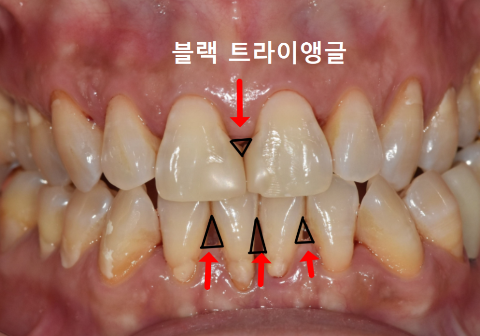 고덕동 치과 누런 이, 앞니 사이 틈, 잘못된 관리 때문일까? 관련 이미지 5