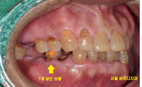 망월동 치과 어금니 빠짐 임플란트 대안이 될 수 있습니다. 관련 이미지 3