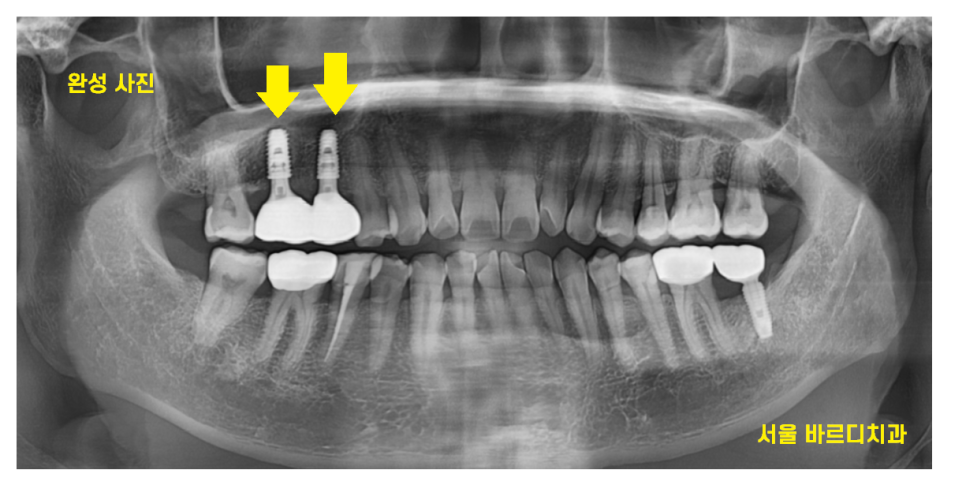 고덕역 임플란트 잇몸 뾰루지 뼈이식 두번 하여 해결했습니다. 관련 이미지 10
