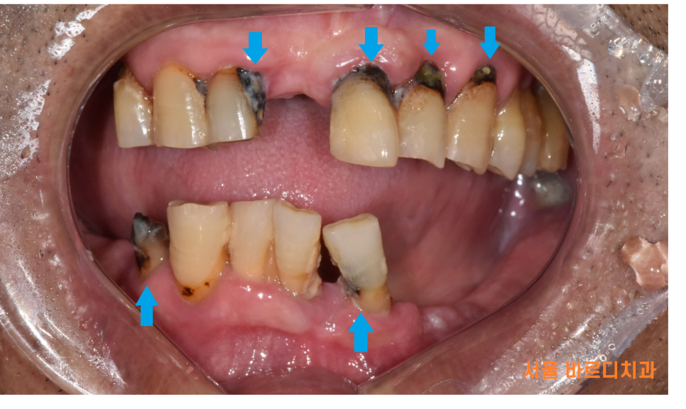 외국인 치과 진료 하악 전체 임플란트 7개 심어 12개 치아 만들기 관련 이미지 3