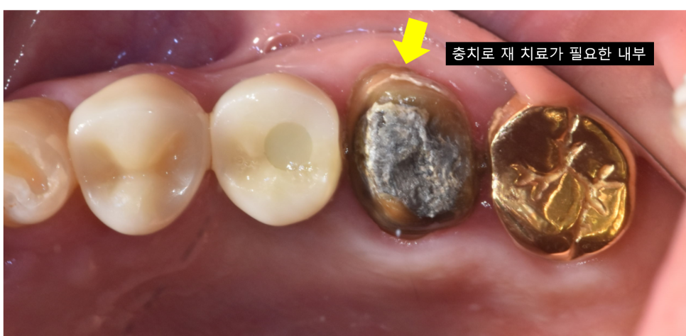 씌운 치아 빠짐 원인 내부 상태가 치료를 결정합니다. 관련 이미지 3