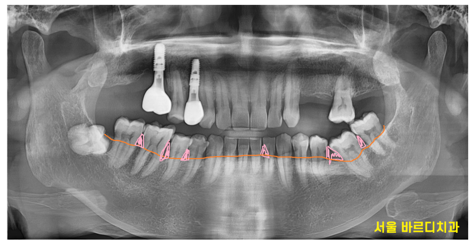 음식물 끼임 생겼다고 이쑤시개 쓰면 안되는 이유 관련 이미지 2