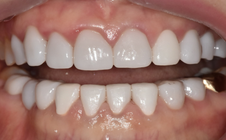 누런 치아 연예인치아 처럼 하얗게 만들 수 있나요? 관련 이미지 13