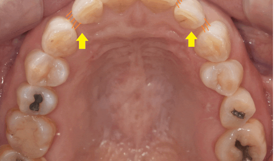 고덕동 교정치과 앞니 사이 틈 부분교정으로 치아 삭제없이 공간 없애기 관련 이미지 1