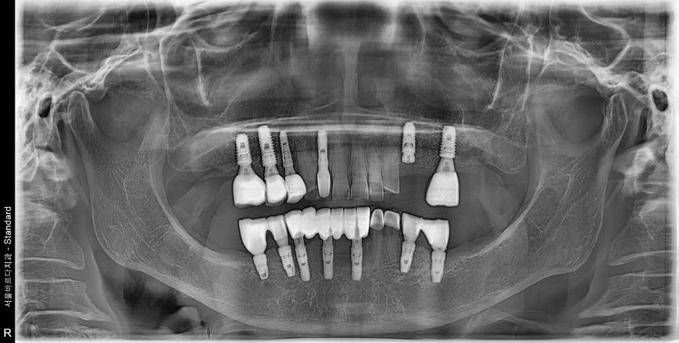 상일동역임플란트 고혈압, 골다공증 80대 환자의 안전한 임플란트 치료 관련 이미지 5