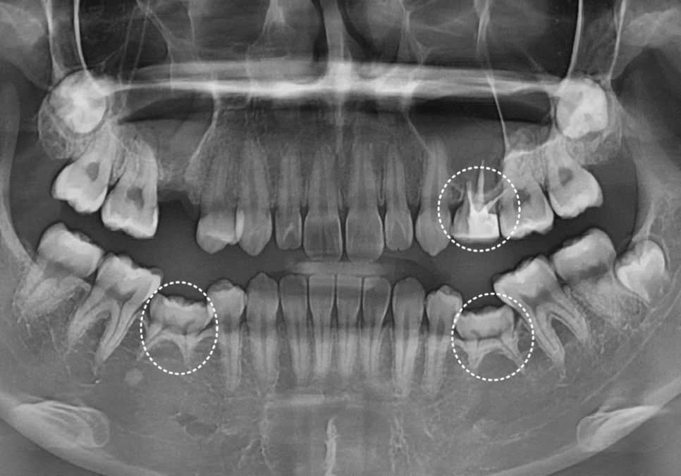 얇은 잇몸뼈 때문에 임플란트 하기 힘들다면? 저희는 관련 이미지 12