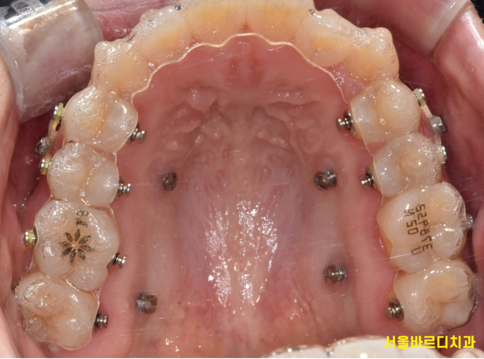 강일동 치아교정 과정 시작부터 마무리까지 알려드려요! 관련 이미지 4