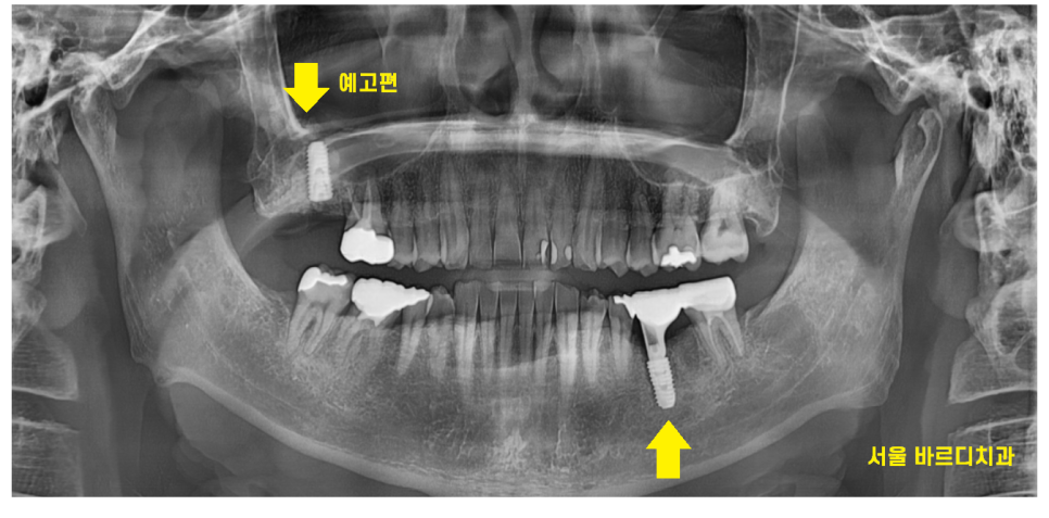 고덕역 치과 치아뿌리 파절 부러짐 있을 때 임플란트로 대체해야죠 관련 이미지 8