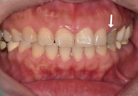 앞니가 검게 변색된 이유, 신경치료 후 꼭 크라운으로 씌워야 하는 걸까요? 관련 이미지 9